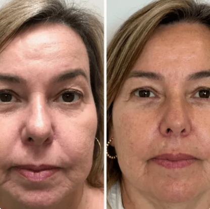 Collagen Fit - Efeito lifting imediato sem agulhas nem dor.