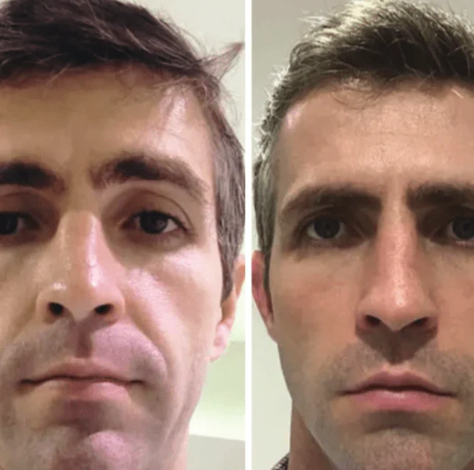 Collagen Fit - Efeito lifting imediato sem agulhas nem dor.