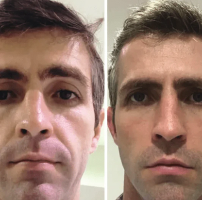 Collagen Fit - Efeito lifting imediato sem agulhas nem dor.