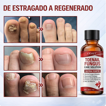 ODALT™ - Diga adeus às unhas com fungos