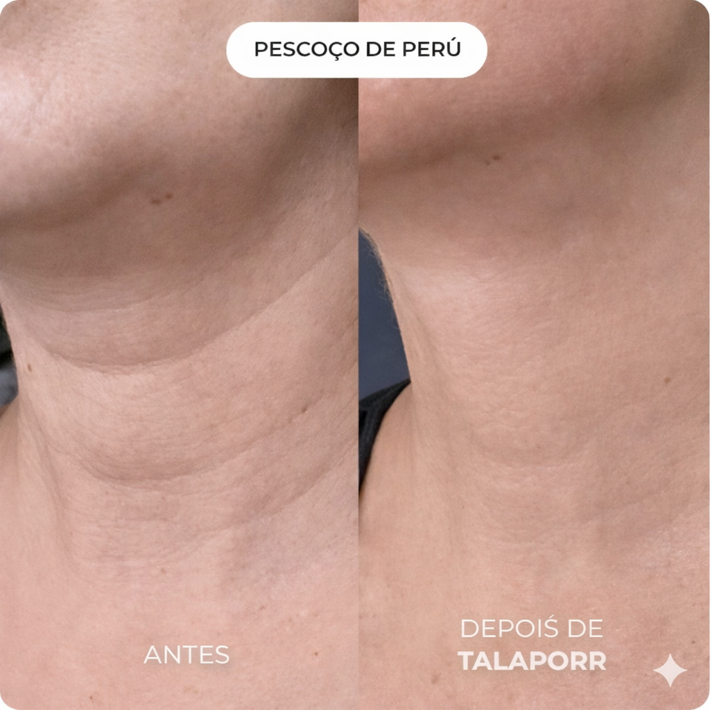 Talaporr - Elimina rugas profundas e recupera firmeza natural, sem intervenções clínicas!