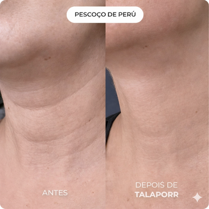 Talaporr - Elimina rugas profundas e recupera firmeza natural, sem intervenções clínicas!