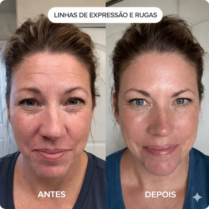 Talaporr - Elimina rugas profundas e recupera firmeza natural, sem intervenções clínicas!